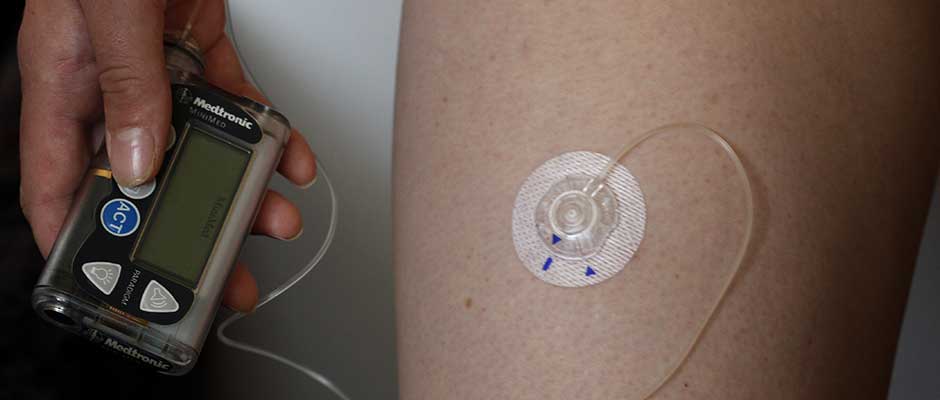 Inzulinska pumpa pričvršćena za nogu | Insulin Pump Attached to Leg