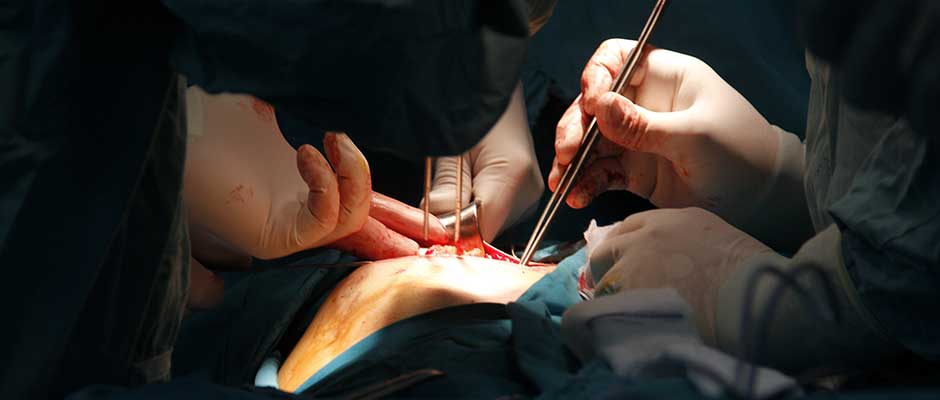 Hirurzi za vrijeme operacije - krupni plan | Close up of Surgeons Operating